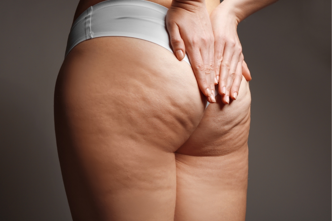 Tutto sulla cellulite