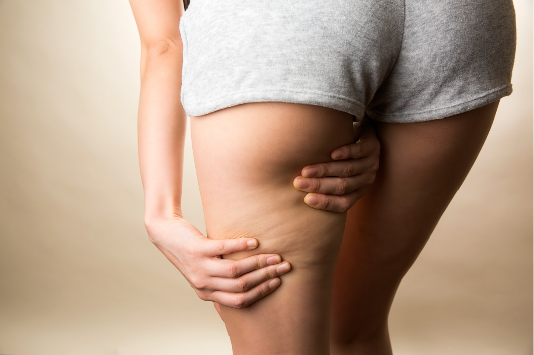 Gli stadi della cellulite