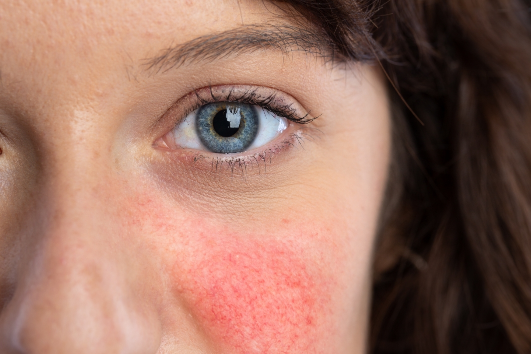 3 cose da non fare prima del dermapen
