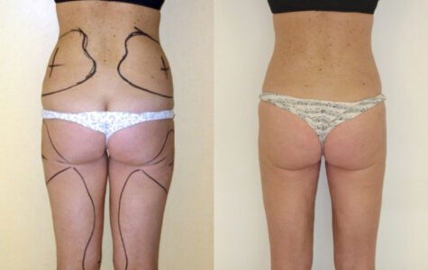 prima-e-dopo-liposuzione-liposcultura