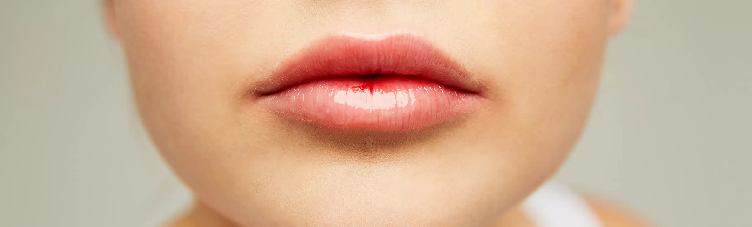 Primo piano delle labbra di una modella, mostrando i risultati del trattamento di medicina estetica combinato Anti Age Lips, con labbra più piene, definite e idratate grazie a un trattamento che riduce i segni del tempo e migliora la texture delle labbra