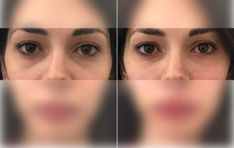 prima-e-dopo-filler-occhiaie