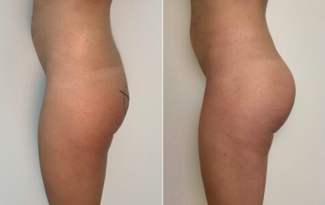 prima-dopo-gluteoplastica-milano-roma-bologna-torino