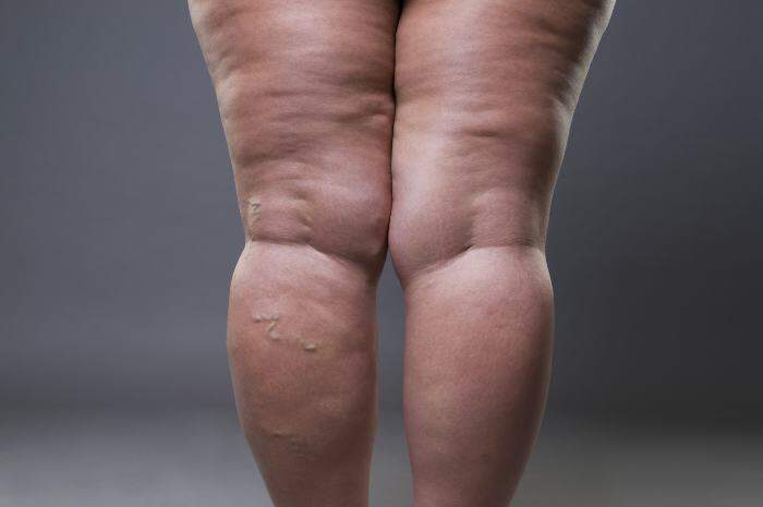 lipedema